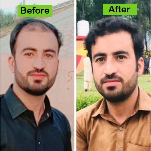 Hair-3-before-after-dr-khan-clinic