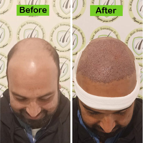 Hair-4-before-after-dr-khan-clinic