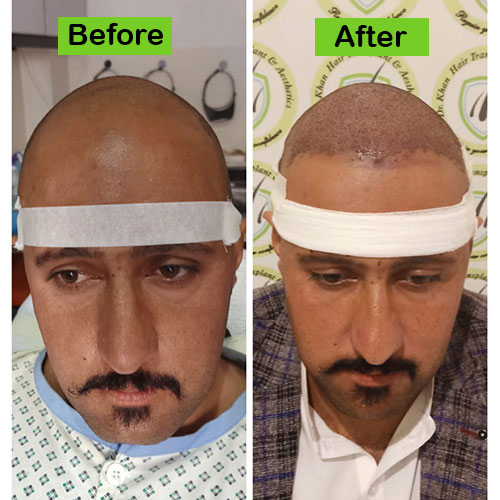 Hair-5-before-after-dr-khan-clinic