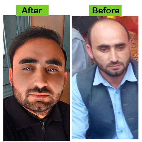 Hair-6-before-after-dr-khan-clinic