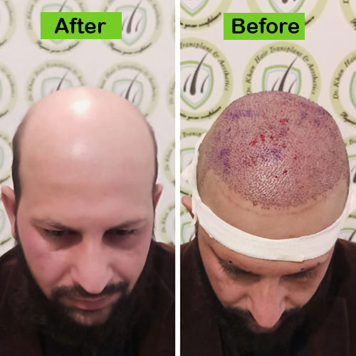 Hair-7-before-after-dr-khan-clinic