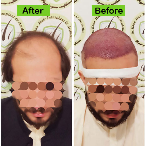 Hair-8-before-after-dr-khan-clinic