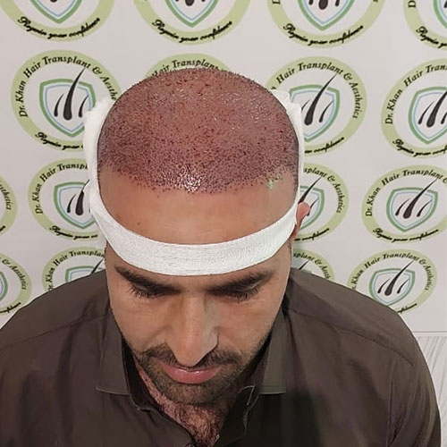 hair-transplant-treatment